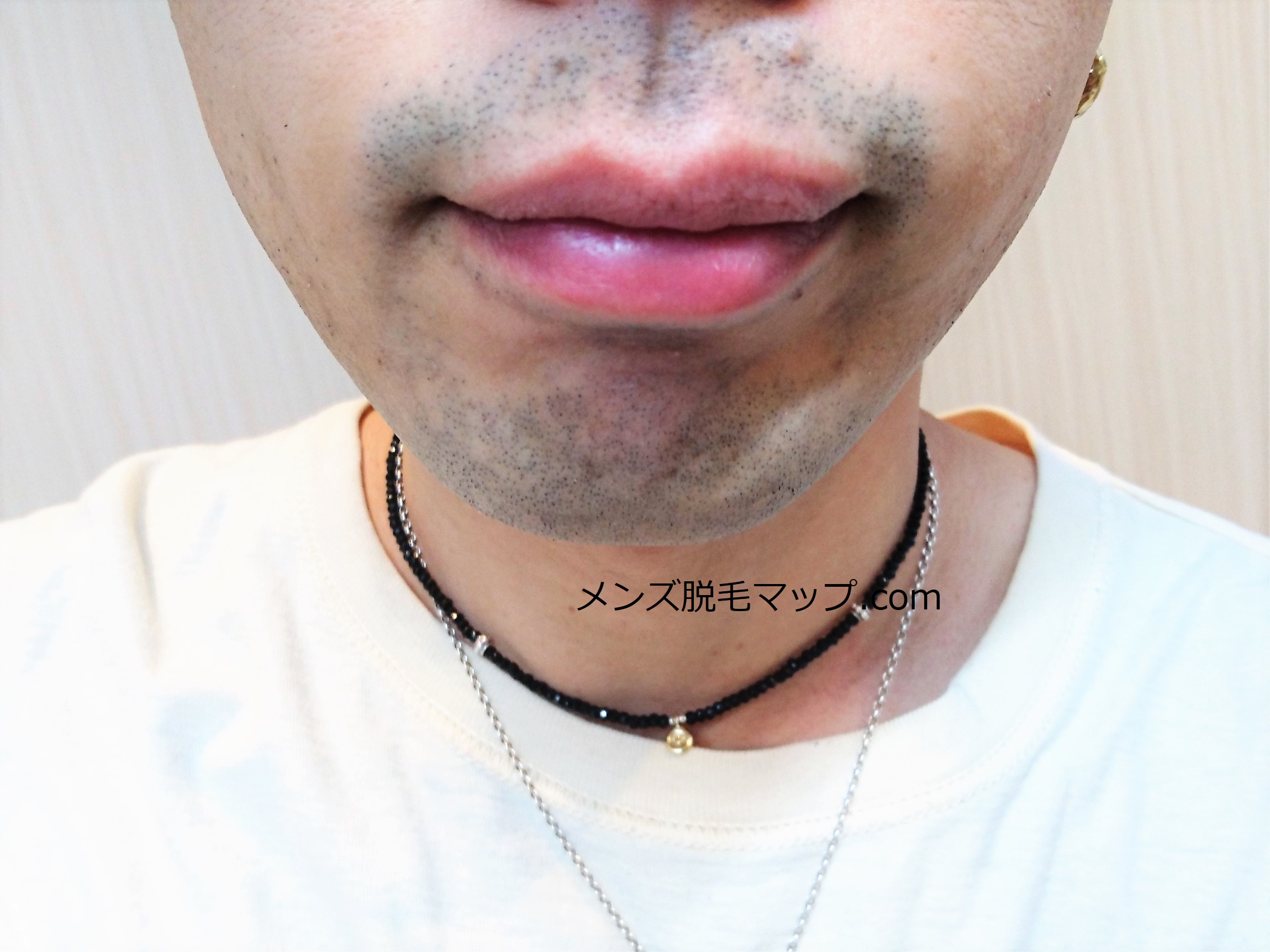 【ヒゲ脱毛】医療脱毛体験談！何回で綺麗になれるのか！？（１回目）